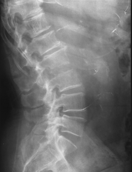 columna_lumbosacra_lordosis_corta