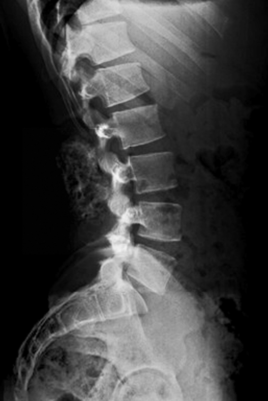 Dolor Columna Lumbosacra y fisioterapia con visión global