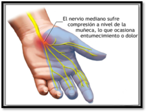 sindrome-tunel-carpiano-fisioterapia-ibiza